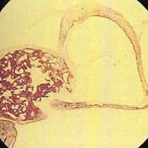 Otosklerose Otosklerose