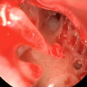 Endoskopische Ohrchirurgie Endoskopische Ohrchirurgie