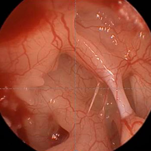 Endoskopische Ohrchirurgie Endoskopische Ohrchirurgie