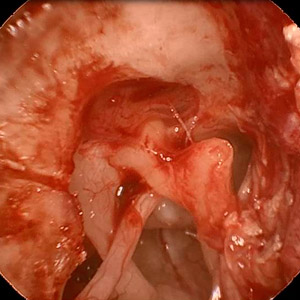 Endoskopische Ohrchirurgie Endoskopische Ohrchirurgie