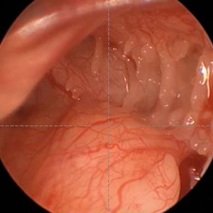 Endoskopische Ohrchirurgie Endoskopische Ohrchirurgie